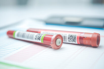 高尿酸血症の診断基準と検査